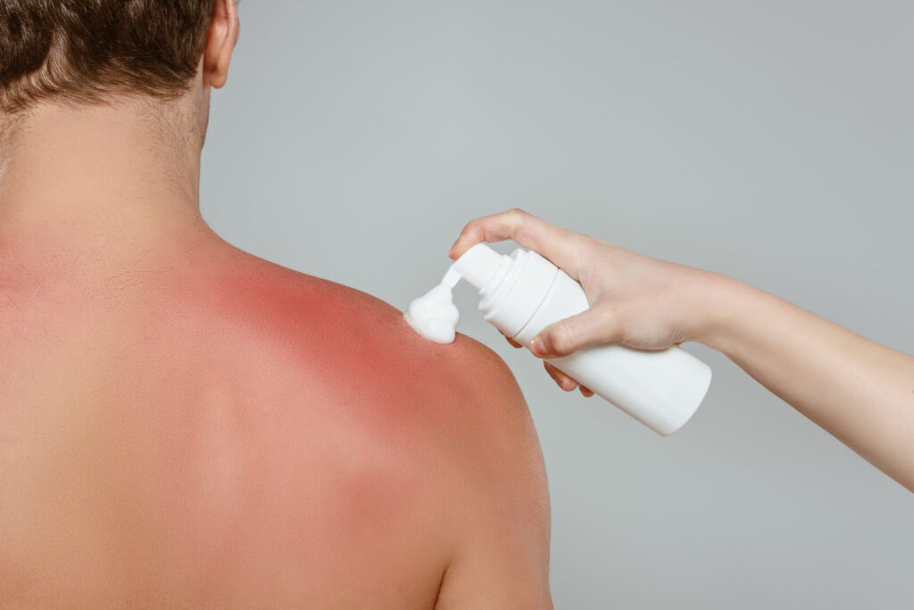 does beef tallow help with sunburn