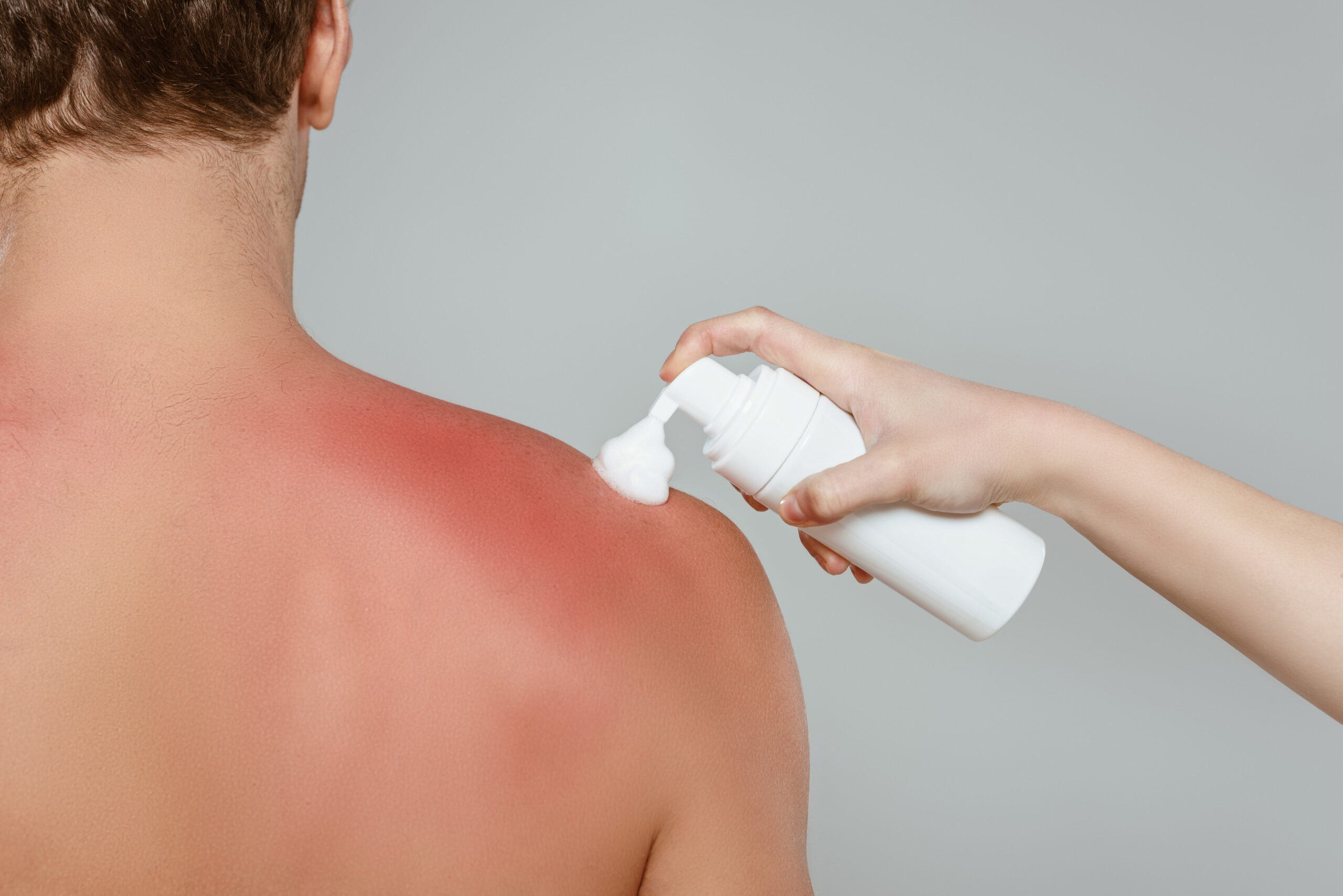 does beef tallow help with sunburn